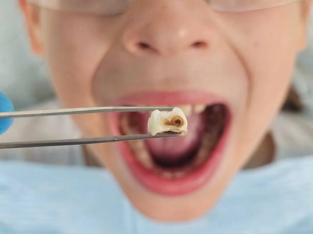 Best Emergency Dentist for Lost Fillings or Crowns in Lmdale, PA